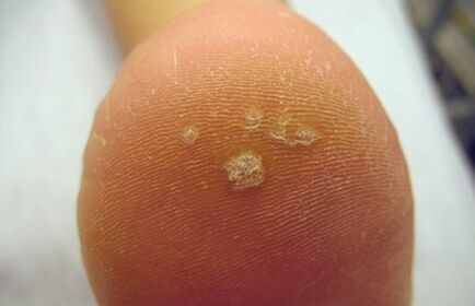 Comment reconnaître une verrue de Pierce
