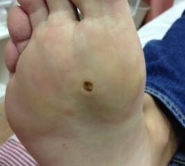 Façons de retirer la verrue autour de la semelle des jambes