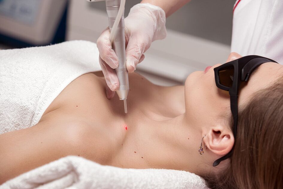 Élimination du laser des papillomas