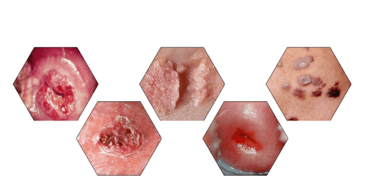 Pourquoi les papillomes sont dangereux