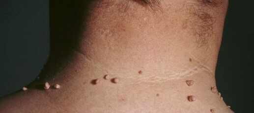 comment se débarrasser des papillomes