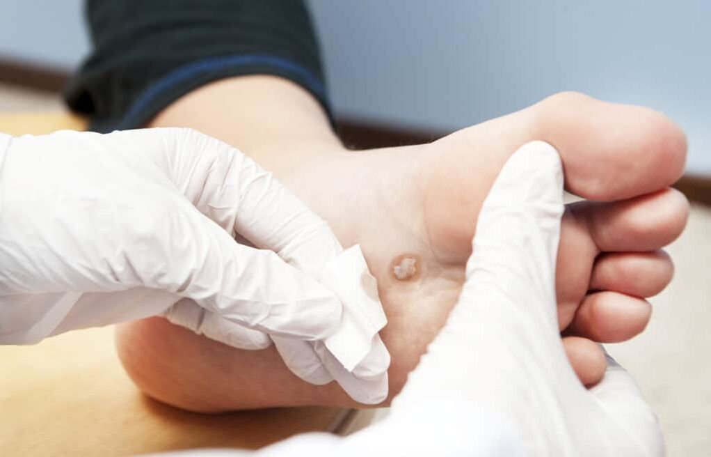 pourquoi les verrues apparaissent sur le corps