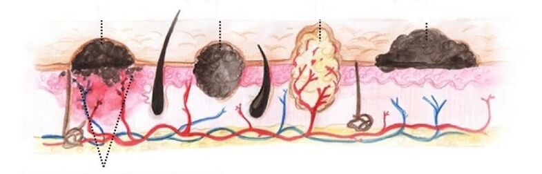 types de papillomes sur le corps humain