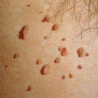 Les papillomes se développent souvent en colonies et peuvent apparaître sur la peau sur tout le corps. 